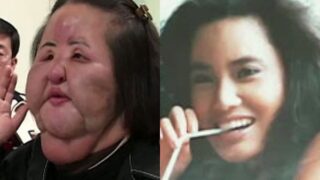 「扇風機おばさん」ハン・ヘギョン、顔の異物だけで4kg…「自ら大豆油を注入」