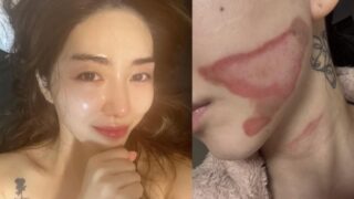 "顔に深在性2度火傷"...クォン・ミンア、リフティング施術を受けながら"ハッ