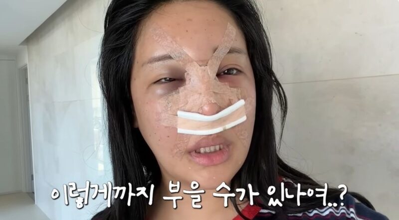 衝撃！ララル、鼻手術・目下脂肪→今度はフィラー副作用？「唇＝顔の半分」