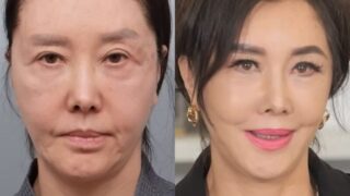 62歳ユ・ヘリ、顔面リフトアップ＆脂肪再配置で2週間で別人に「周りが大騒ぎ」