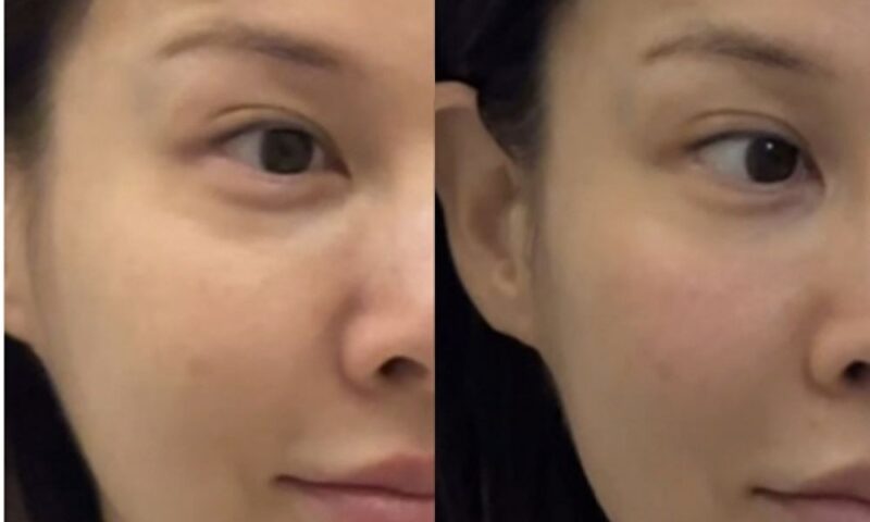 「43歳」アイビー、施術後180度変わった顔を公開…「美しくなる前にもう一度」